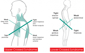 upper-and-lower-crossed-syndrome1